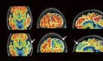 Ces images révélées par PET scan et fournies par le New England Journal of Medicine en janvier 2024 montrent une réduction des niveaux de bêta-amyloïde chez un patient atteint de la maladie d’Alzheimer après un traitement par ultrasons focalisés visant à ouvrir la barrière hématoencéphalique au bout de 26 semaines. Le rouge est associé à des niveaux plus élevés de bêta-amyloïde.